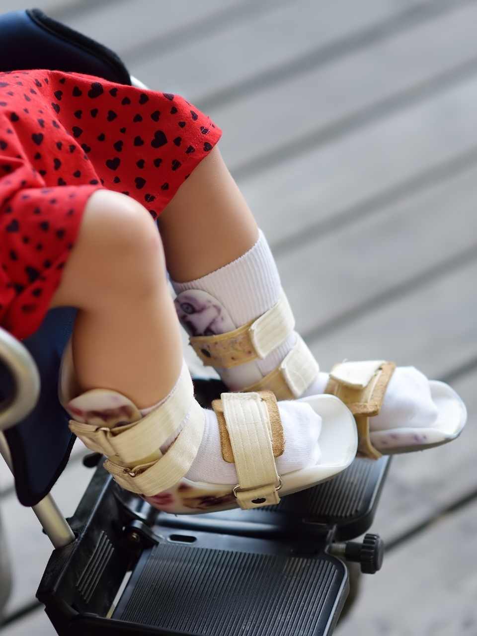 Serebral Palsi ve Robotik Rehabilitasyon